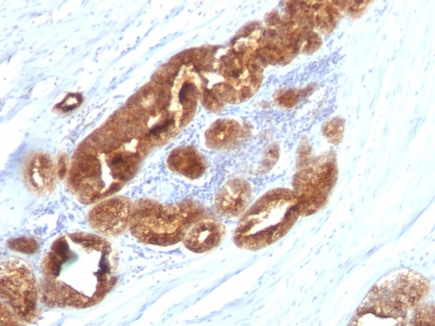 FFPE human prostate carcinoma sections stained with 100 ul anti-TAG-72 / CA72.4 (clone CC49) at 1:300. HIER epitope retrieval prior to staining was performed in 10mM Citrate, pH 6.0.